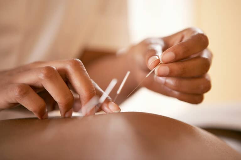 The difference between acupuncture and dry needling