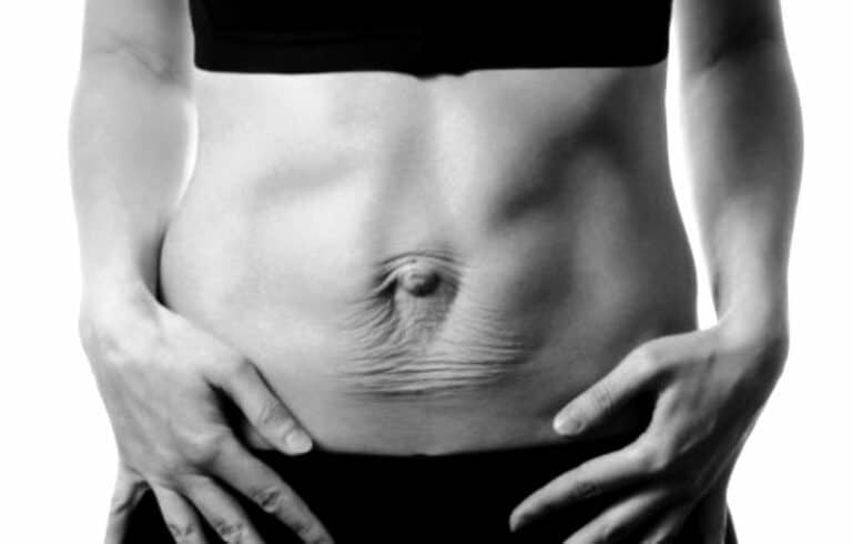 What is Diastasis Recti and How can Pilates Help?