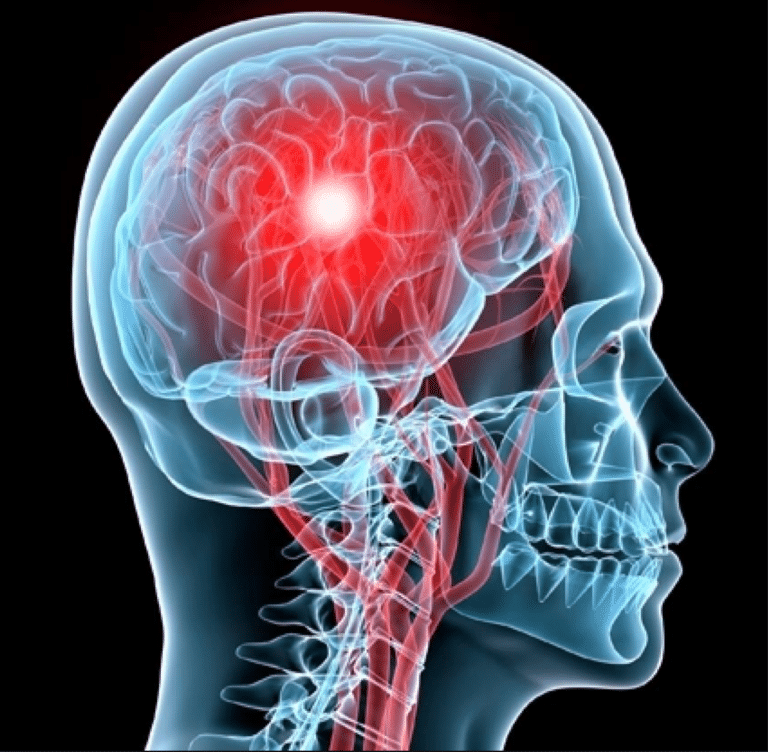 Concussions – Early Intervention